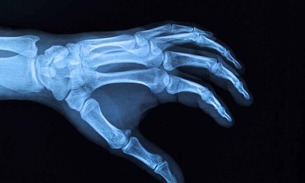 Cyborg Craze Makes Thousands of Swedes Implant Subdermal Microchips